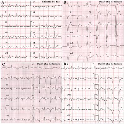 Sintilimab-Induced Myocarditis Overlapping Myositis in a Patient With Metastatic Thymoma: A Case Report